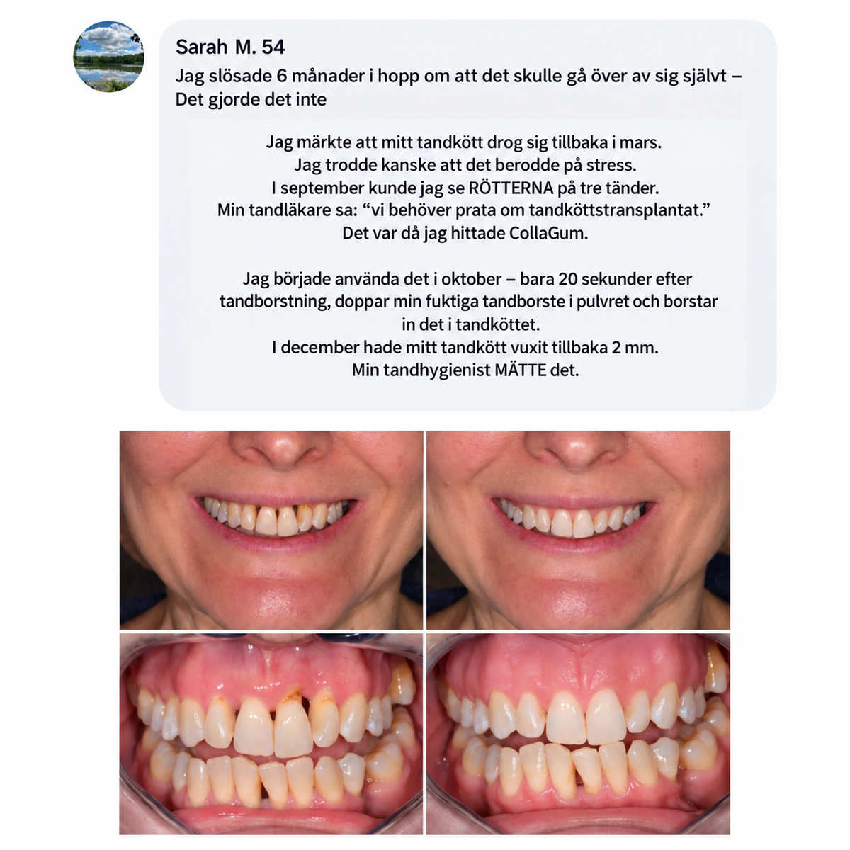 GumGuard™ | Dagligt kollagenstöd för starkare och friskare tandkött