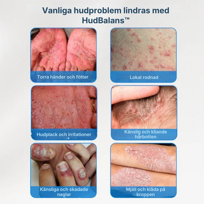 HudBalans™ | Leave-on hudvård för torr, fjällande och kliande hud