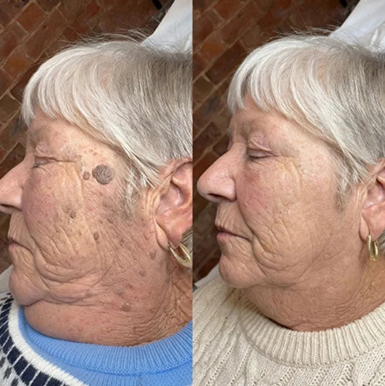HudRen™ | Effektivt serum mot vårtor och hudförändringar