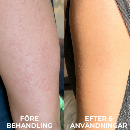 Strawberry Skin™ | Keratosis Pilaris-återfuktande kräm
