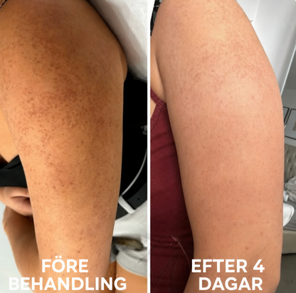 Strawberry Skin™ | Keratosis Pilaris-återfuktande kräm