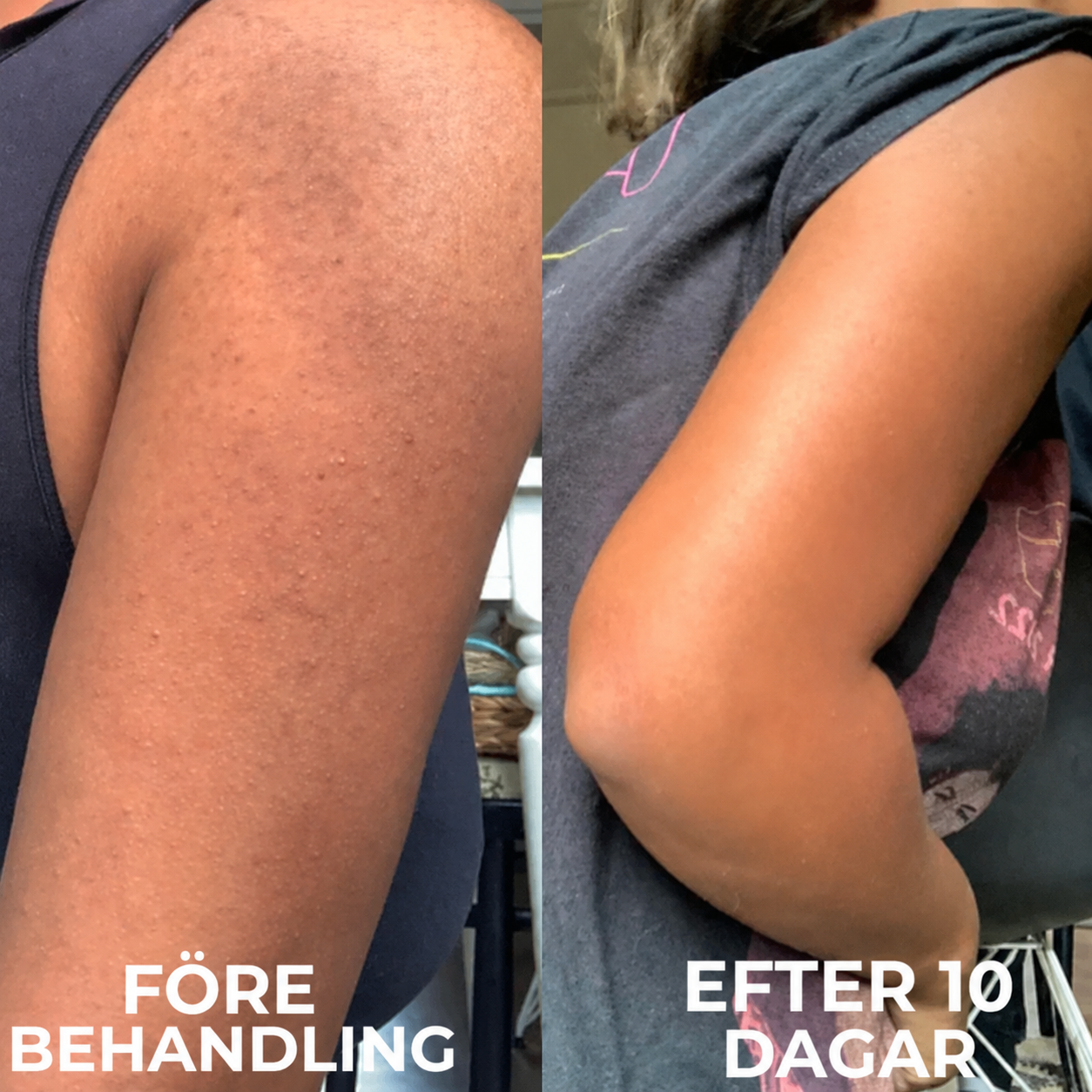 Strawberry Skin™ | Keratosis Pilaris-återfuktande kräm