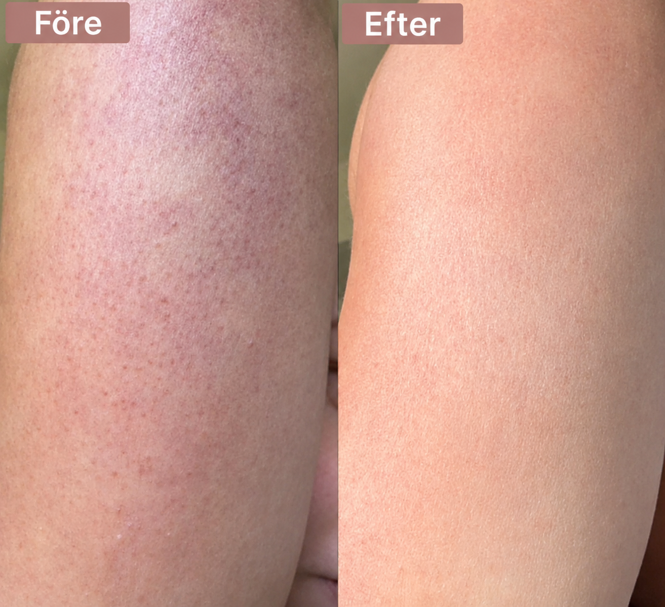 Strawberry Skin™ | Keratosis Pilaris-återfuktande kräm