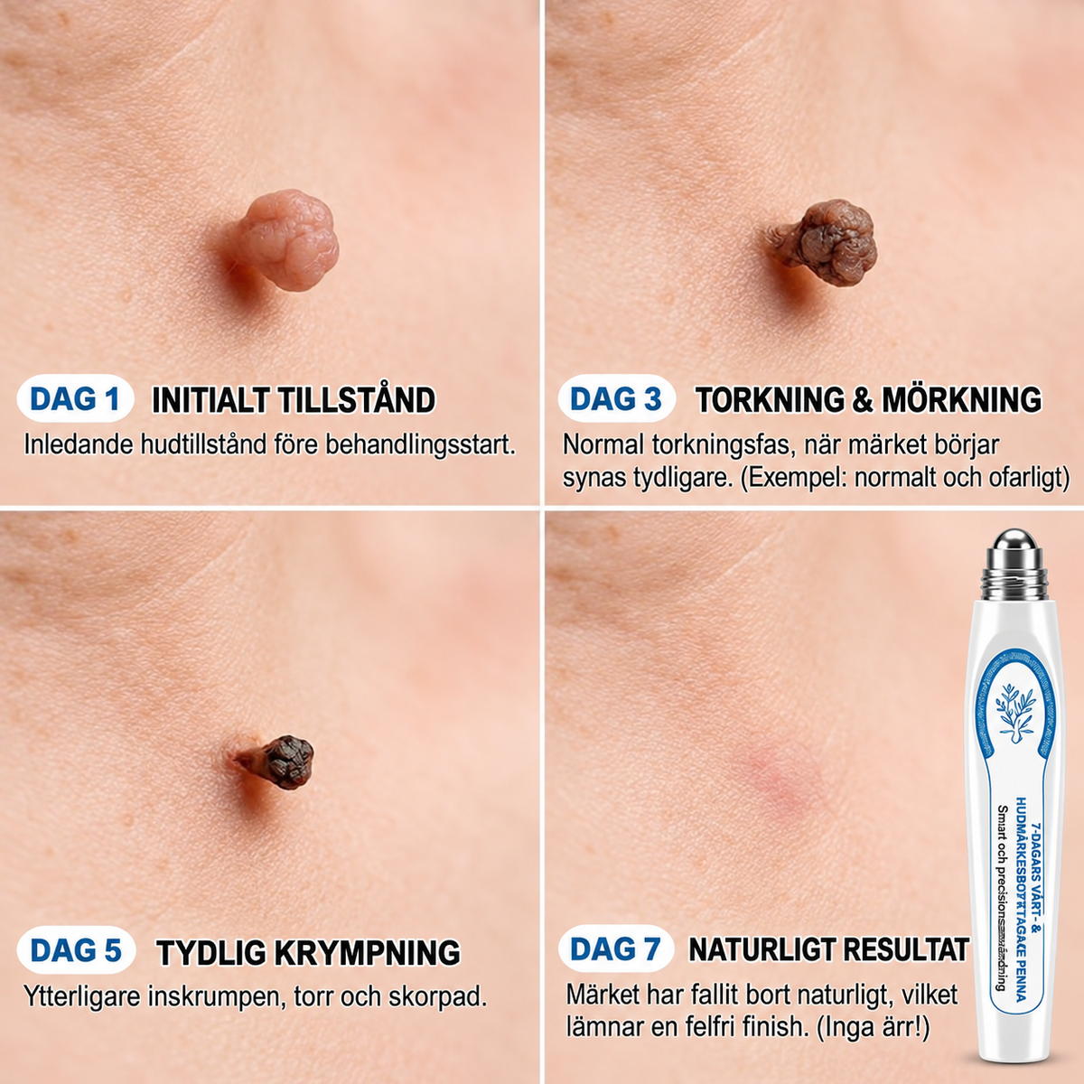 HudRen™ | Effektivt serum mot vårtor och hudförändringar